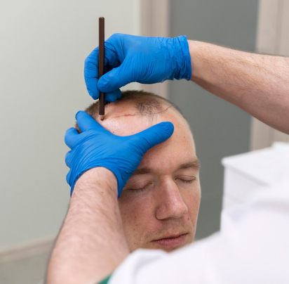 Hair Restoration