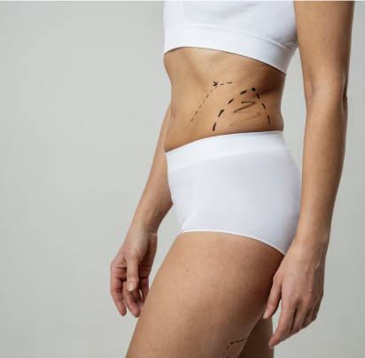 Liposuction