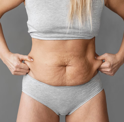 Tummy Tuck